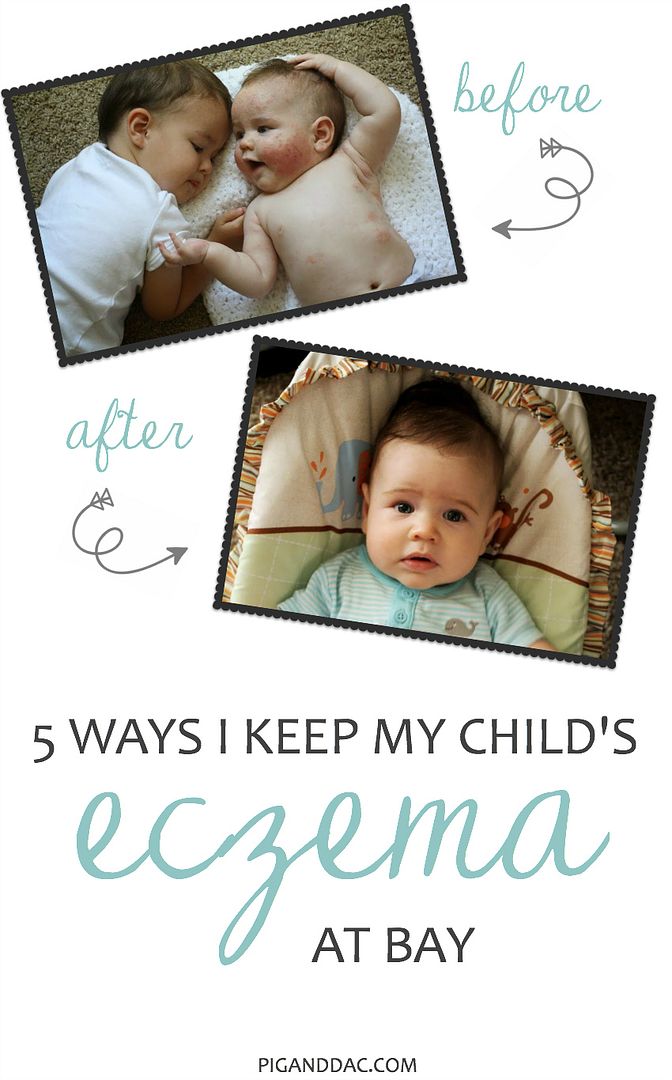 5 Ways I Keep My Child's Eczema At Bay Pig & Dac